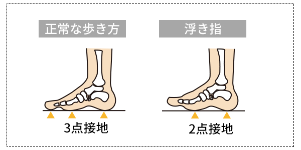 正常な人の歩き方と浮き指の人の歩き方