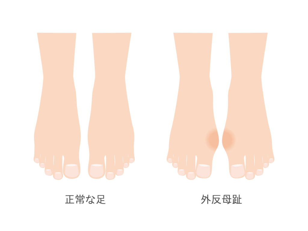 通常の足と外反母趾