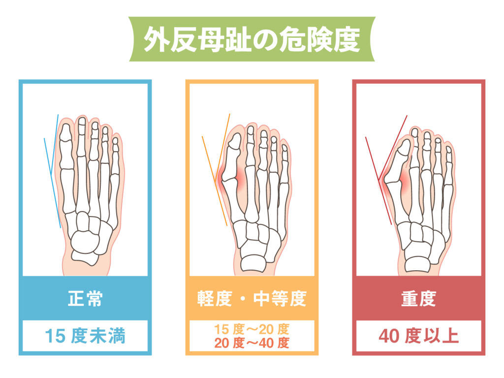 外反母趾危険度チェック