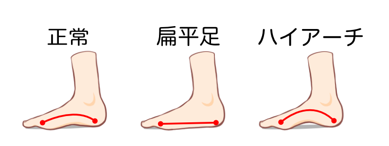 通常の足と扁平足とハイアーチ比較