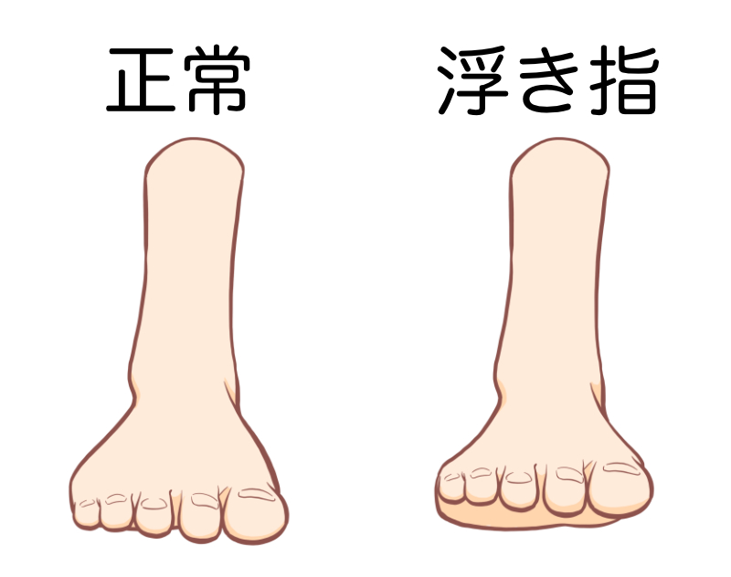正常の足と浮き指