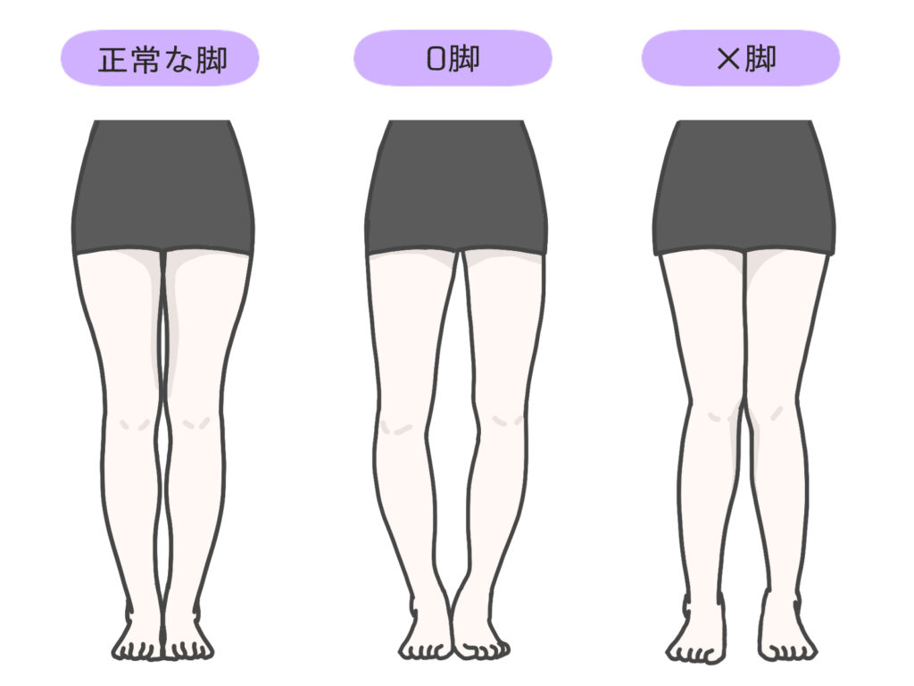 正常の足とO脚とX脚